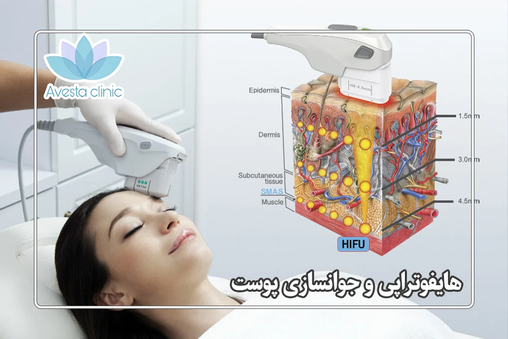 هایفوتراپی