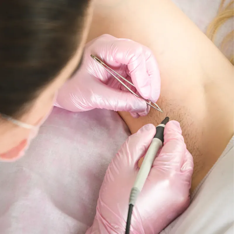 الکترولیز برای حذف موی زائد