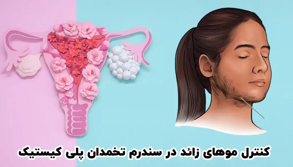 کنترل موهای زائد در سندرم تخمدان پلی کیستیک