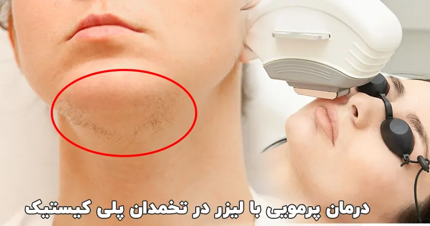 درمان پرمویی با لیزر در تخمدان پلی کیستیک