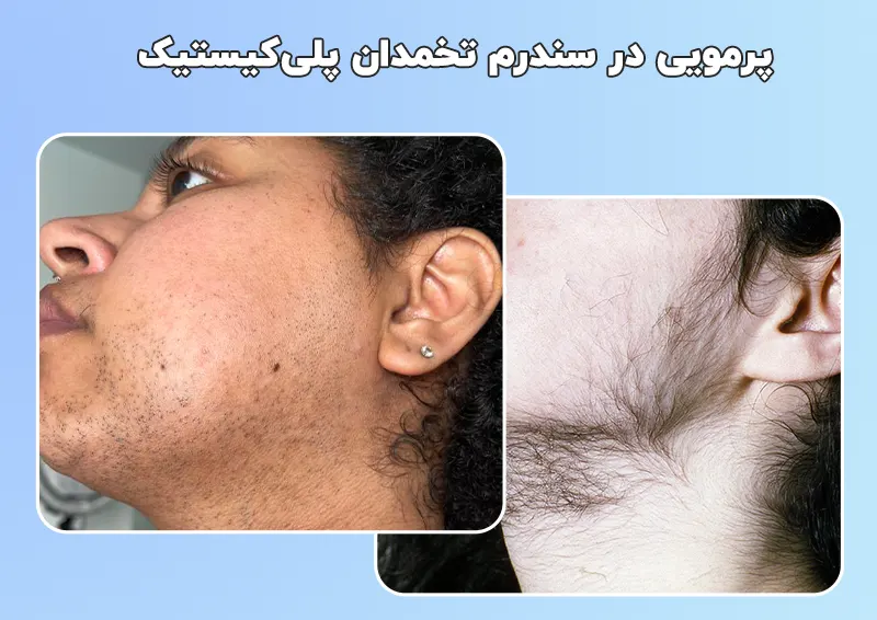 موهای زائد در سندرم تخمدان پلی کیستیک