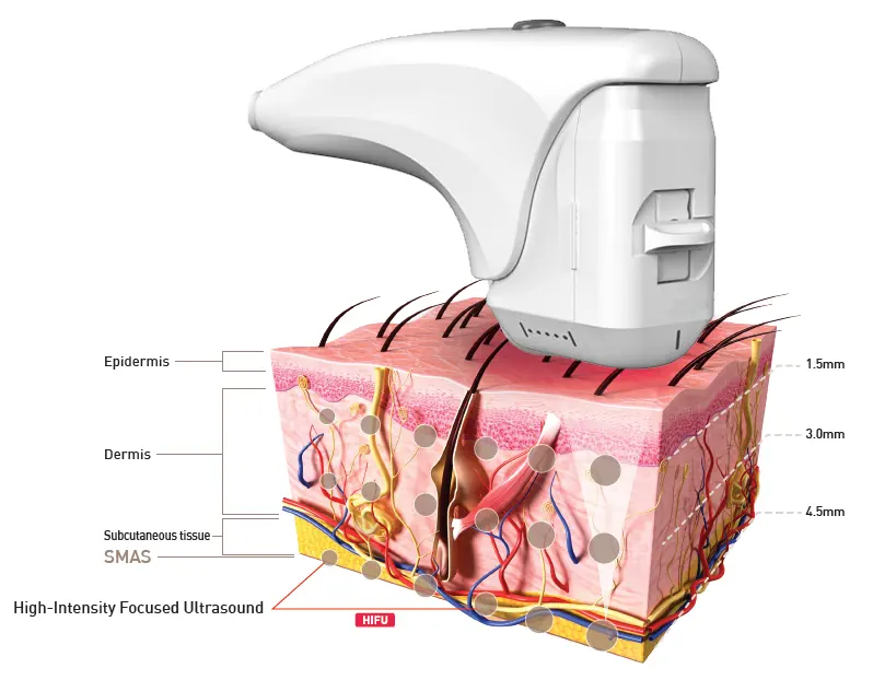 هایفوتراپی