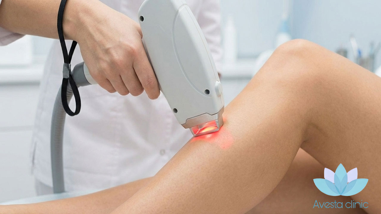 مقایسه الکترولیز و لیزر مو