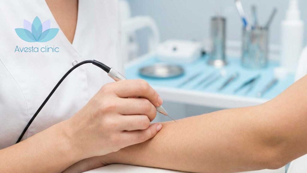 الکترولیز یا لیزر