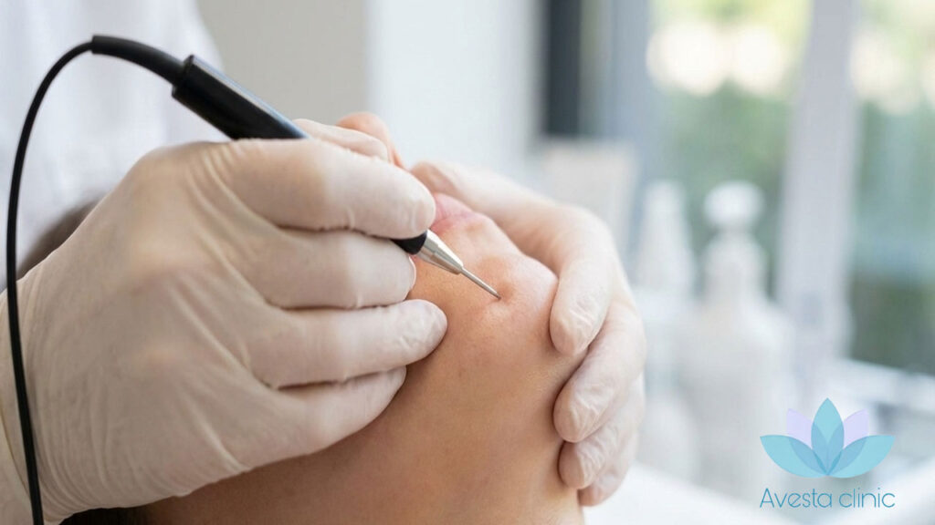 الکترولیز مو