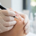 الکترولیز مو